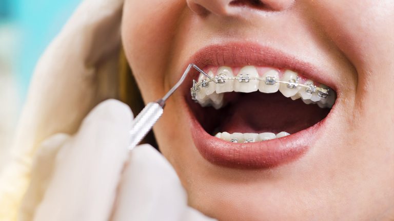 ORTHODONTIC TREATMENT