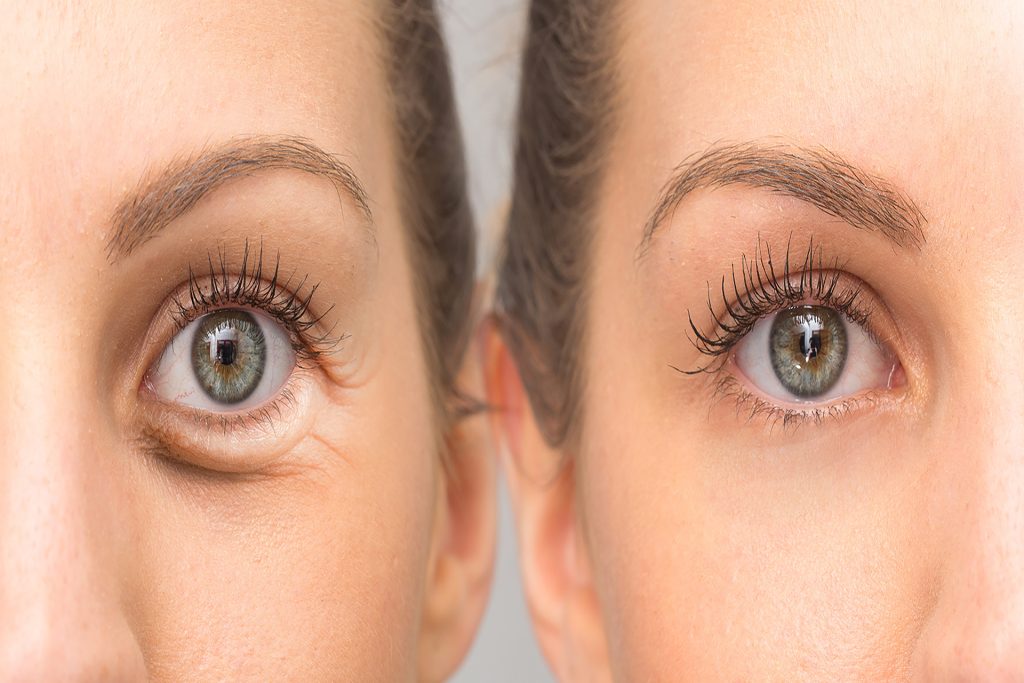 eye lid 632981303